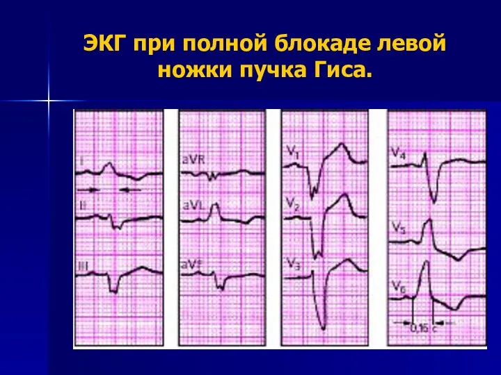 ЭКГ при полной блокаде левой ножки пучка Гиса.