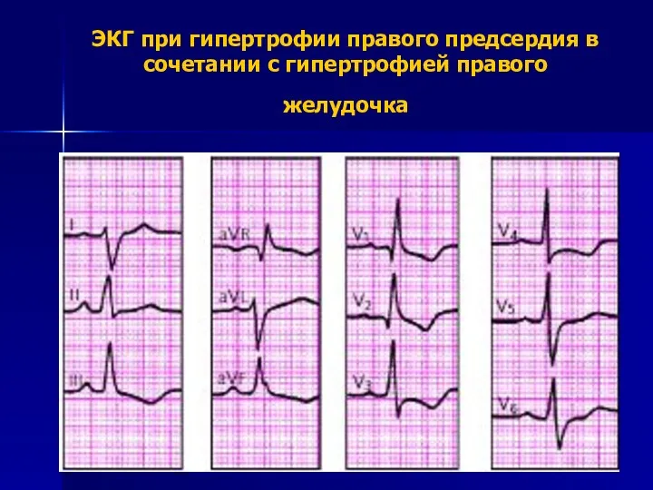 ЭКГ при гипертрофии правого предсердия в сочетании с гипертрофией правого желудочка