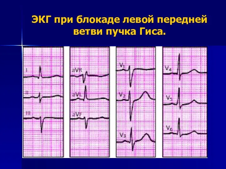 ЭКГ при блокаде левой передней ветви пучка Гиса.