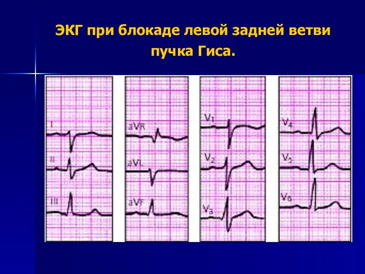 ЭКГ при блокаде левой задней ветви пучка Гиса.