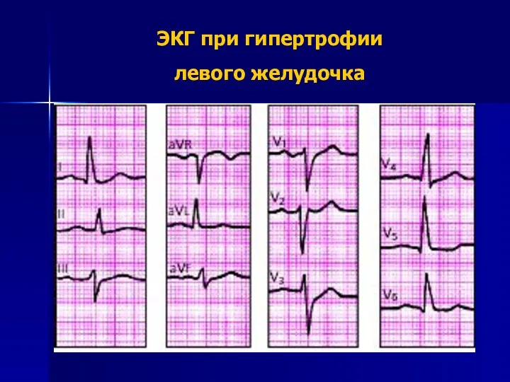 ЭКГ при гипертрофии левого желудочка