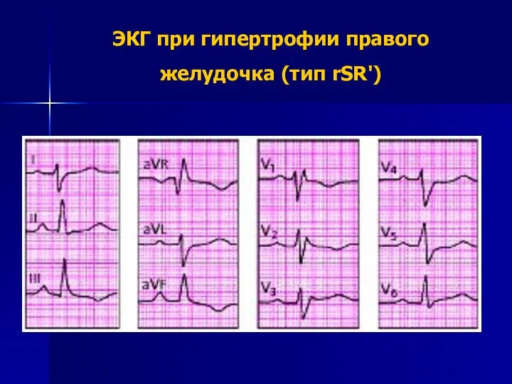 ЭКГ при гипертрофии правого желудочка (тип rSR')