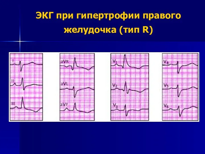 ЭКГ при гипертрофии правого желудочка (тип R)
