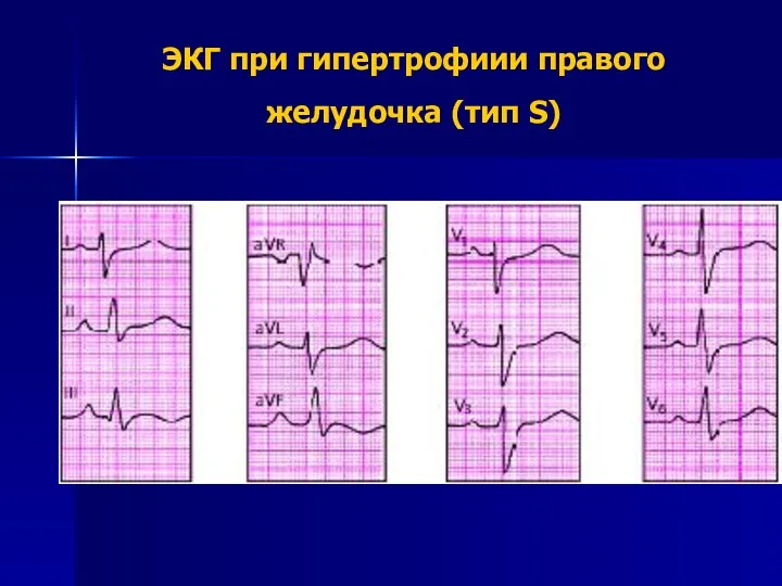 ЭКГ при гипертрофиии правого желудочка (тип S)