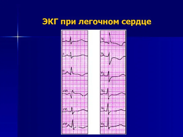 ЭКГ при легочном сердце