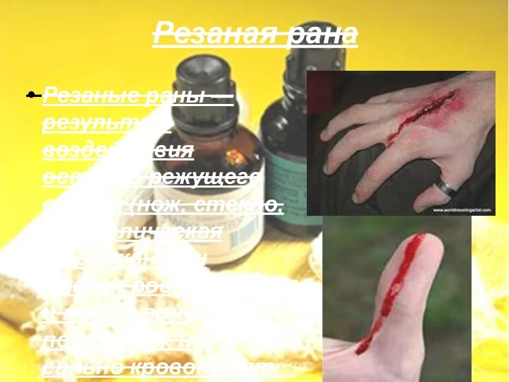 Резаная рана Резаные раны — результат воздействия острого режущего орудия (нож, стекло, металлическая