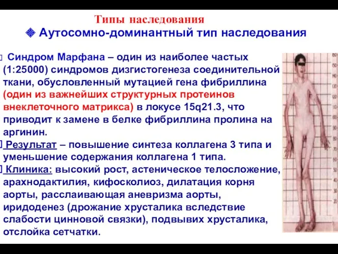 Типы наследования Синдром Марфана – один из наиболее частых (1:25000)