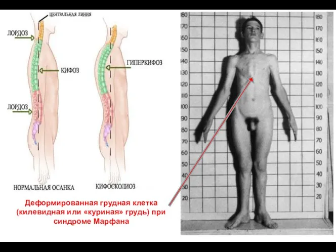 Деформированная грудная клетка (килевидная или «куриная» грудь) при синдроме Марфана