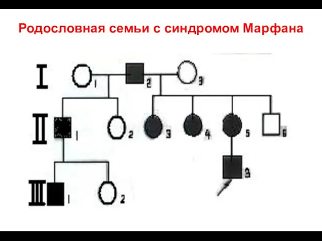 Родословная семьи с синдромом Марфана