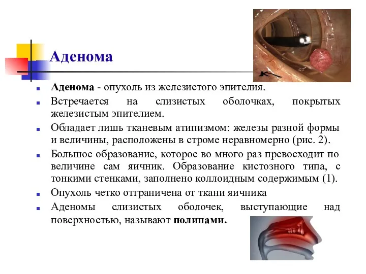 Аденома Аденома - опухоль из железистого эпителия. Встречается на слизистых