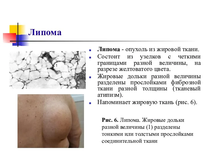 Липома Липома - опухоль из жировой ткани. Состоит из узелков