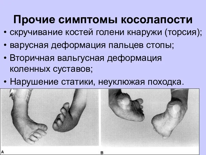 Прочие симптомы косолапости скручивание костей голени кнаружи (торсия); варусная деформация пальцев стопы; Вторичная