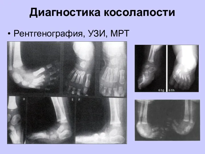 Диагностика косолапости Рентгенография, УЗИ, МРТ