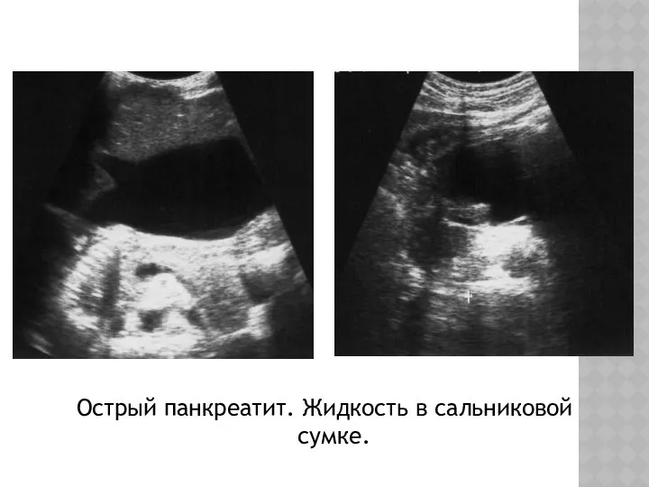 Острый панкреатит. Жидкость в сальниковой сумке.