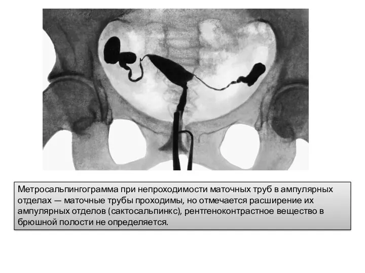 Метросальпингограмма при непроходимости маточных труб в ампулярных отделах — маточные