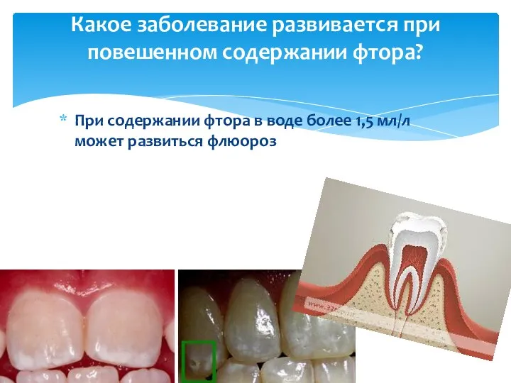 При содержании фтора в воде более 1,5 мл/л может развиться