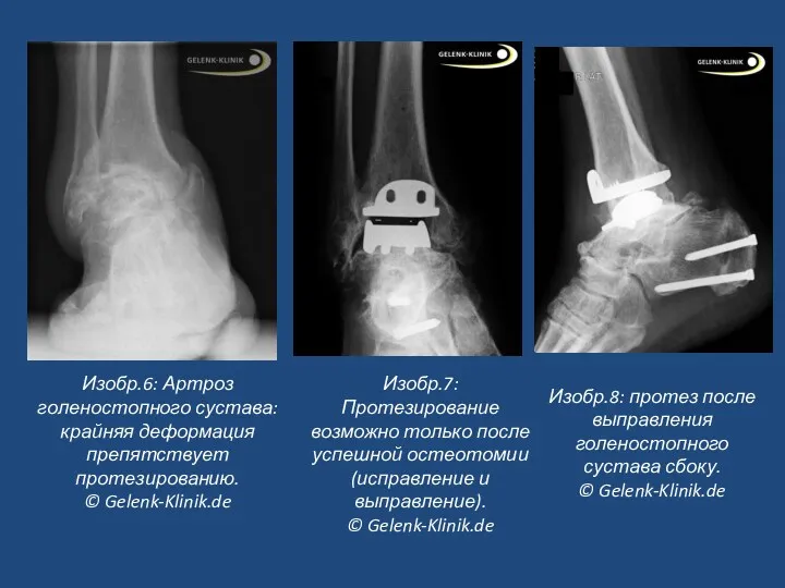 Изобр.6: Артроз голеностопного сустава: крайняя деформация препятствует протезированию. © Gelenk-Klinik.de Изобр.7: Протезирование возможно