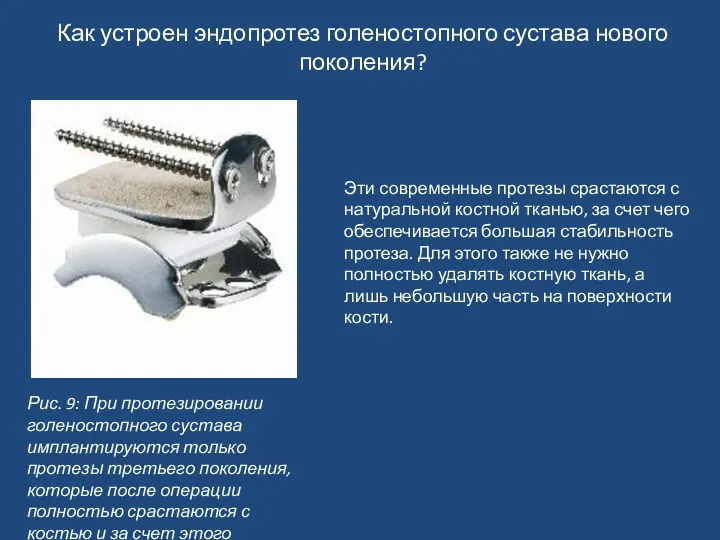 Как устроен эндопротез голеностопного сустава нового поколения? Рис. 9: При протезировании голеностопного сустава