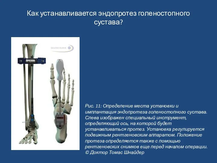 Как устанавливается эндопротез голеностопного сустава? Рис. 11: Определение места установки и имплантация эндопротеза