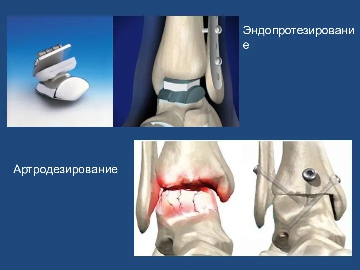 Эндопротезирование Артродезирование