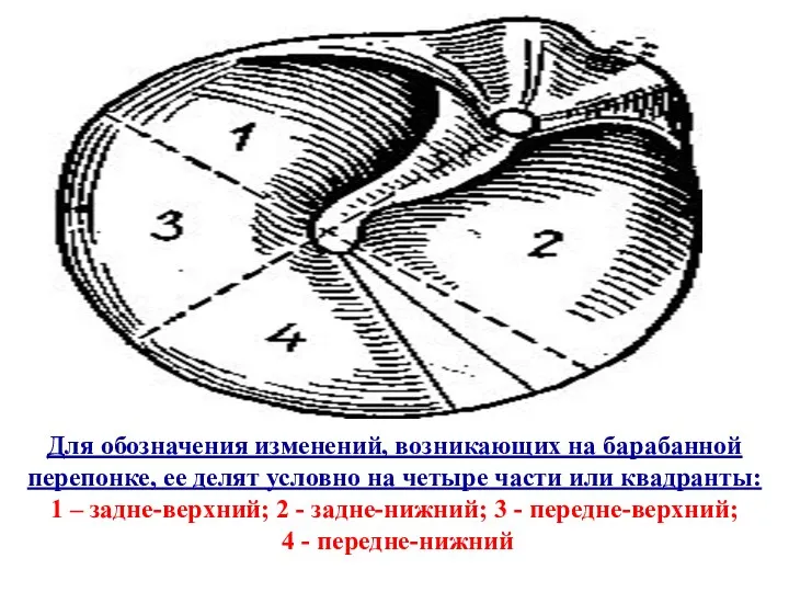 Для обозначения изменений, возникающих на барабанной перепонке, ее делят условно