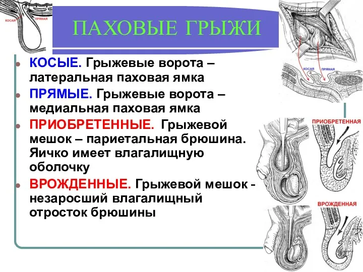 ПАХОВЫЕ ГРЫЖИ КОСЫЕ. Грыжевые ворота – латеральная паховая ямка ПРЯМЫЕ.