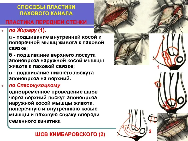 по Жирару (1). а - подшивание внутренней косой и поперечной мышц живота к