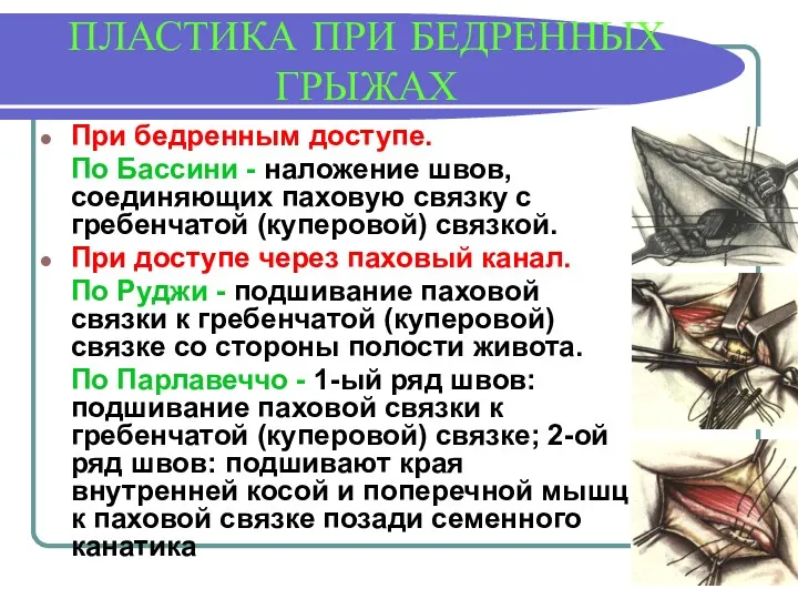 ПЛАСТИКА ПРИ БЕДРЕННЫХ ГРЫЖАХ При бедренным доступе. По Бассини - наложение швов, соединяющих