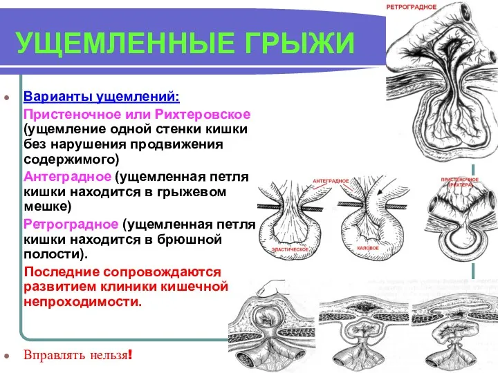 УЩЕМЛЕННЫЕ ГРЫЖИ Варианты ущемлений: Пристеночное или Рихтеровское (ущемление одной стенки кишки без нарушения