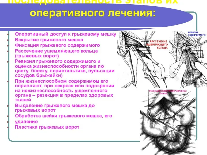 последовательность этапов их оперативного лечения: Оперативный доступ к грыжевому мешку