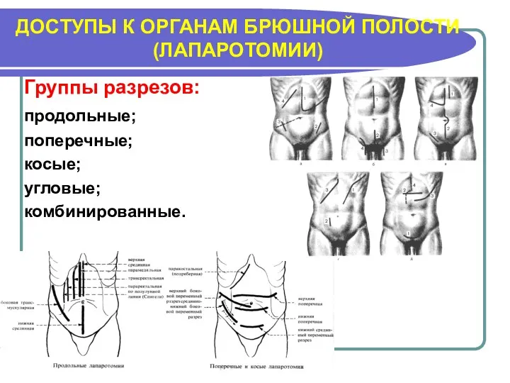 ДОСТУПЫ К ОРГАНАМ БРЮШНОЙ ПОЛОСТИ (ЛАПАРОТОМИИ) Группы разрезов: продольные; поперечные; косые; угловые; комбинированные.