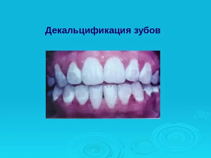 Декальцификация зубов