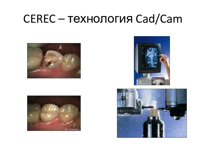 CEREC – технология Cad/Cam