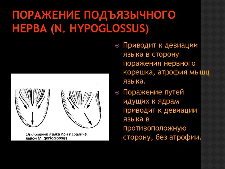 ПОРАЖЕНИЕ ПОДЪЯЗЫЧНОГО НЕРВА (N. HYPOGLOSSUS) Приводит к девиации языка в сторону поражения нервного