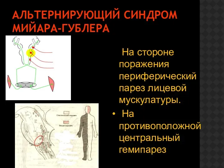 АЛЬТЕРНИРУЮЩИЙ СИНДРОМ МИЙАРА-ГУБЛЕРА На стороне поражения периферический парез лицевой мускулатуры. На противоположной центральный гемипарез