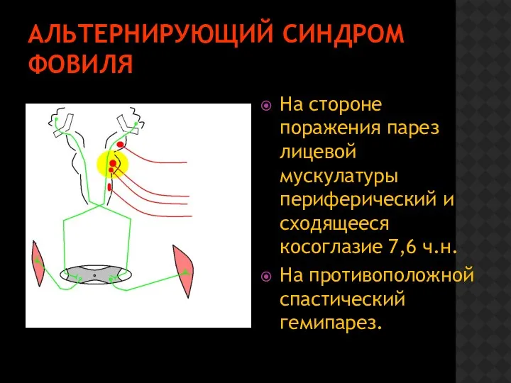 АЛЬТЕРНИРУЮЩИЙ СИНДРОМ ФОВИЛЯ На стороне поражения парез лицевой мускулатуры периферический и сходящееся косоглазие