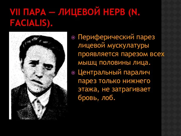 VII ПАРА — ЛИЦЕВОЙ НЕРВ (N. FACIALIS). Периферический парез лицевой мускулатуры проявляется парезом