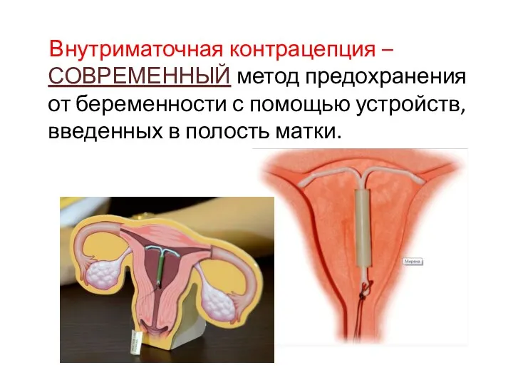 Внутриматочная контрацепция – СОВРЕМЕННЫЙ метод предохранения от беременности с помощью устройств, введенных в полость матки.