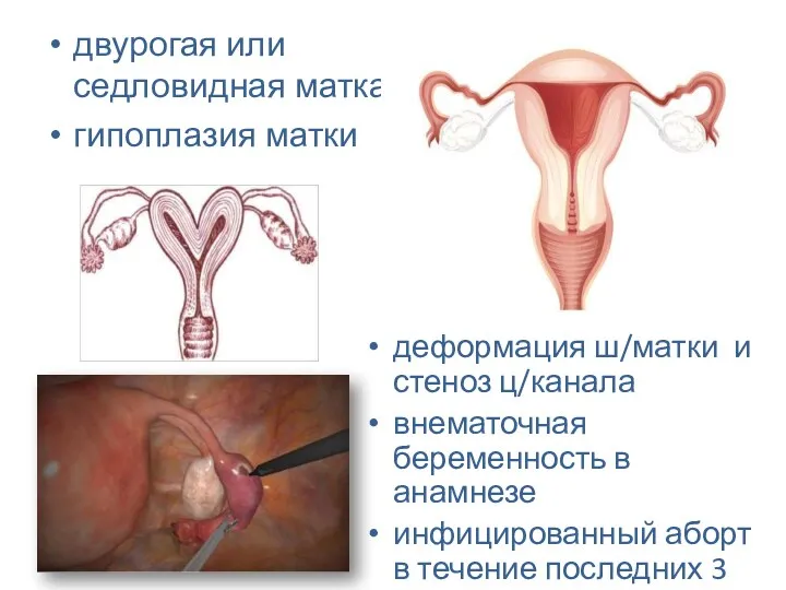 двурогая или седловидная матка гипоплазия матки деформация ш/матки и стеноз