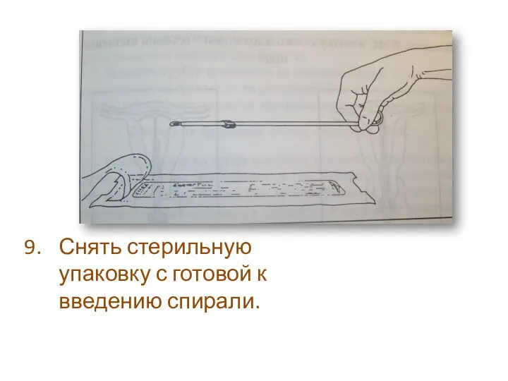 Снять стерильную упаковку с готовой к введению спирали.