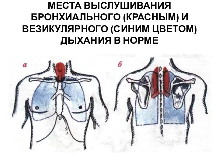 МЕСТА ВЫСЛУШИВАНИЯ БРОНХИАЛЬНОГО (КРАСНЫМ) И ВЕЗИКУЛЯРНОГО (СИНИМ ЦВЕТОМ) ДЫХАНИЯ В НОРМЕ