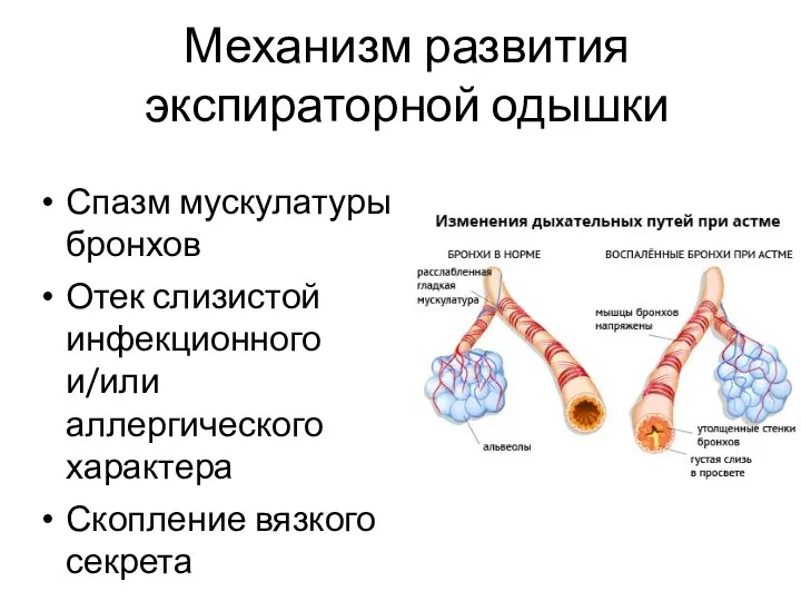 Механизм развития экспираторной одышки Спазм мускулатуры бронхов Отек слизистой инфекционного и/или аллергического характера Скопление вязкого секрета