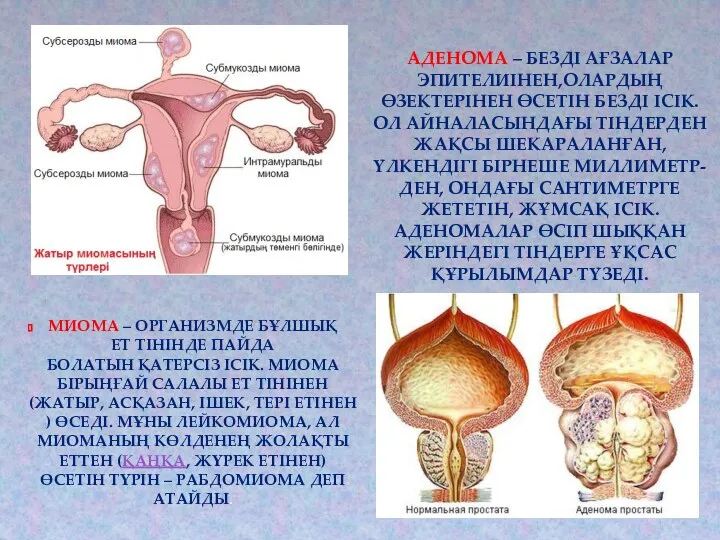 МИОМА – ОРГАНИЗМДЕ БҰЛШЫҚ ЕТ ТІНІНДЕ ПАЙДА БОЛАТЫН ҚАТЕРСІЗ ІСІК.