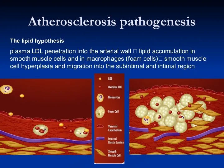 Atherosclerosis pathogenesis The lipid hypothesis plasma LDL penetration into the