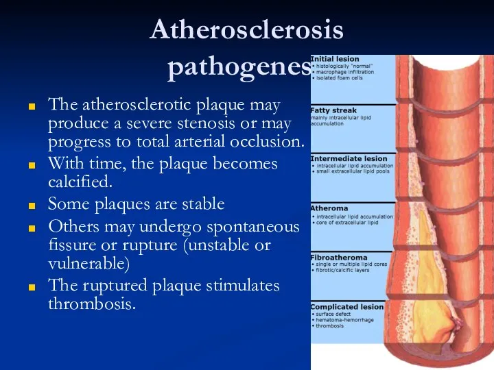 Atherosclerosis pathogenesis The atherosclerotic plaque may produce a severe stenosis