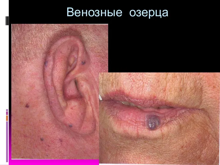 Венозные озерца