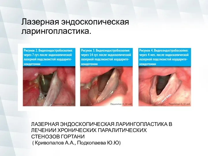 Лазерная эндоскопическая ларингопластика. ЛАЗЕРНАЯ ЭНДОСКОПИЧЕСКАЯ ЛАРИНГОПЛАСТИКА В ЛЕЧЕНИИ ХРОНИЧЕСКИХ ПАРАЛИТИЧЕСКИХ