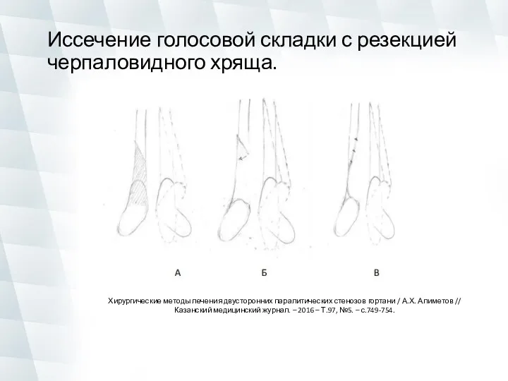 Иссечение голосовой складки с резекцией черпаловидного хряща. Хирургические методы лечения