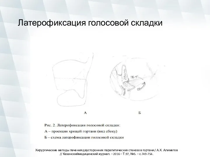 Латерофиксация голосовой складки Хирургические методы лечения двусторонних паралитических стенозов гортани