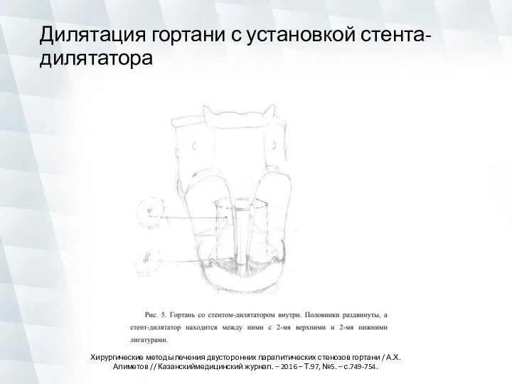 Дилятация гортани с установкой стента-дилятатора Хирургические методы лечения двусторонних паралитических